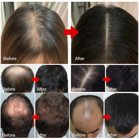 Scalpy Hair Growth Serum