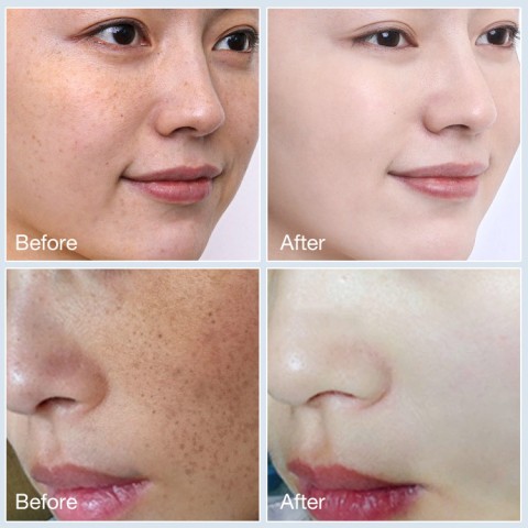 Tranexamic acid anti-freckle cream