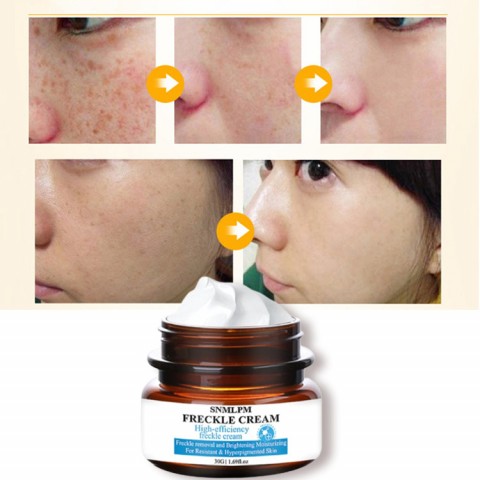 Highlights Chloasma Freckle Removal Cream