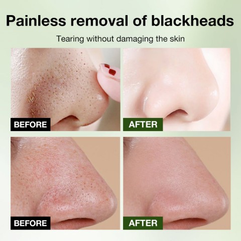 Blackhead removal nose mask